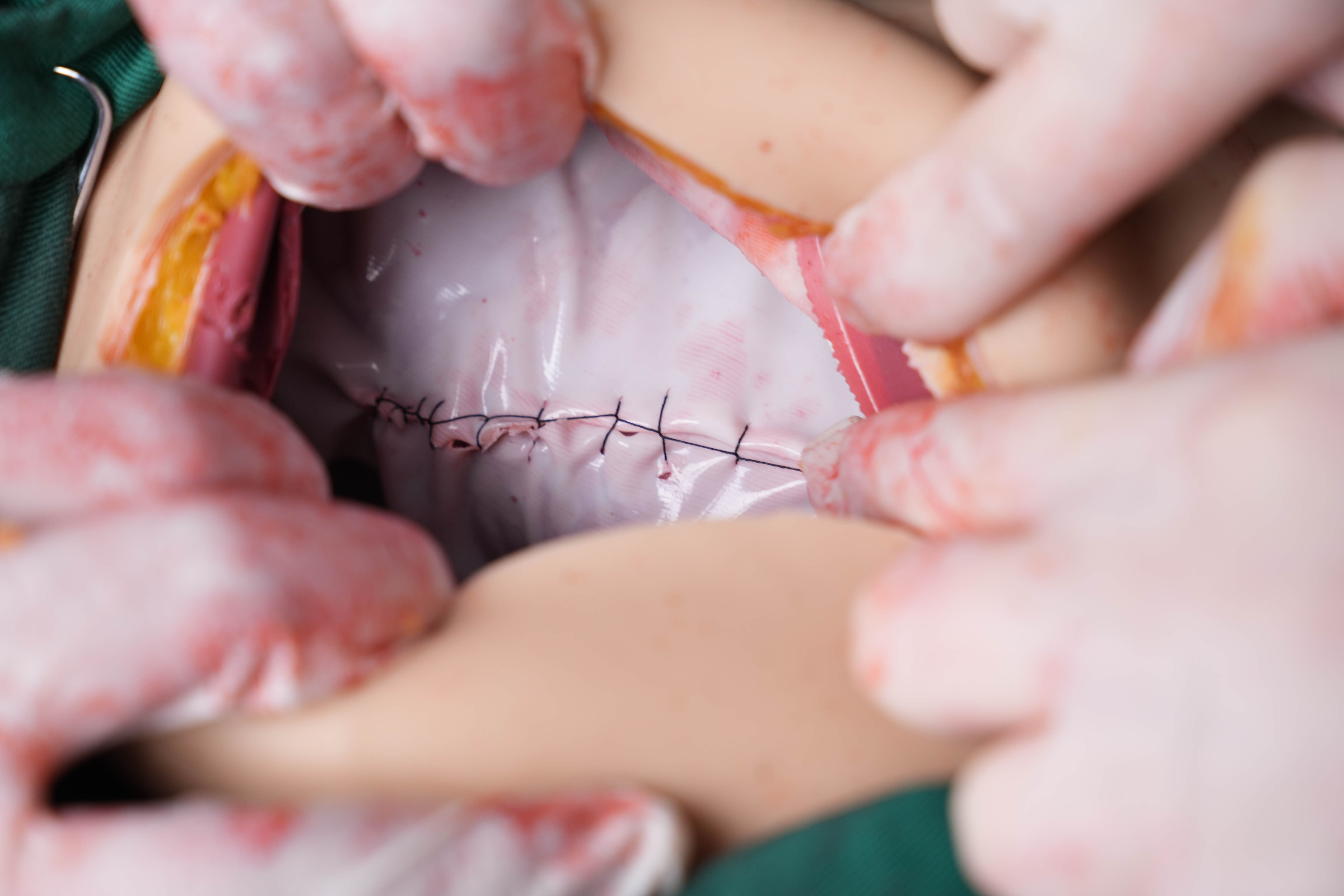 剖宫产手术平台 2.0